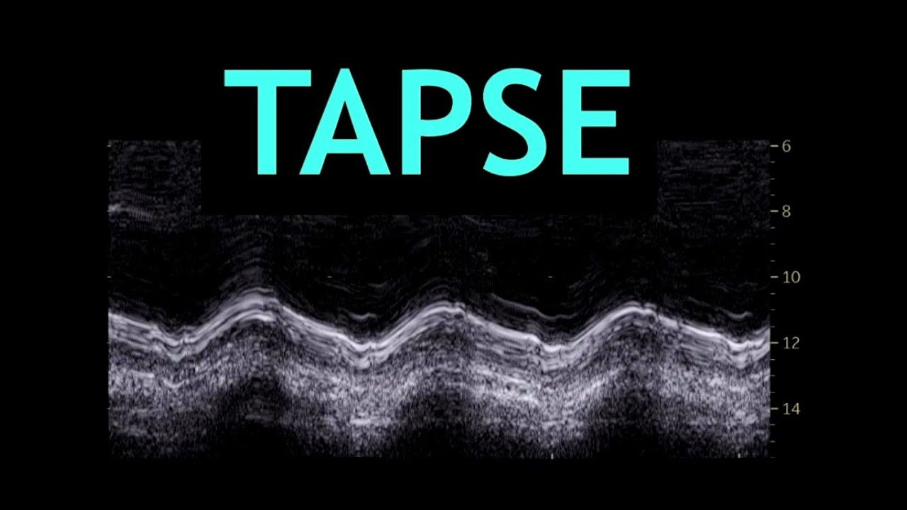 Todo acerca del TAPSE! (Ecocardiografia)