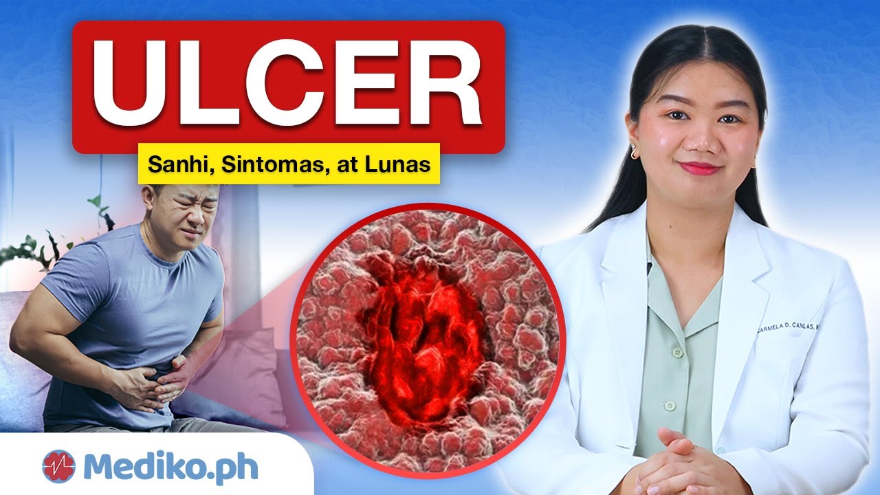 ULCER: Sanhi, Sintomas, at LUNAS
