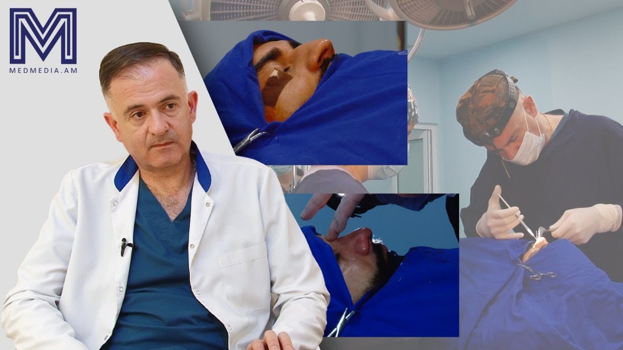 Քթի միջնապատի ուղղում, ռինոպլաստիկա․ ցուցումներ և հակացուցումներ