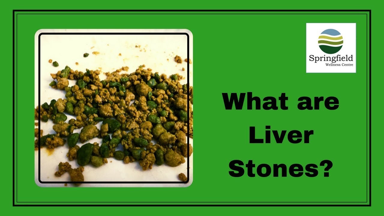Dr Maran - What are Liver Stones