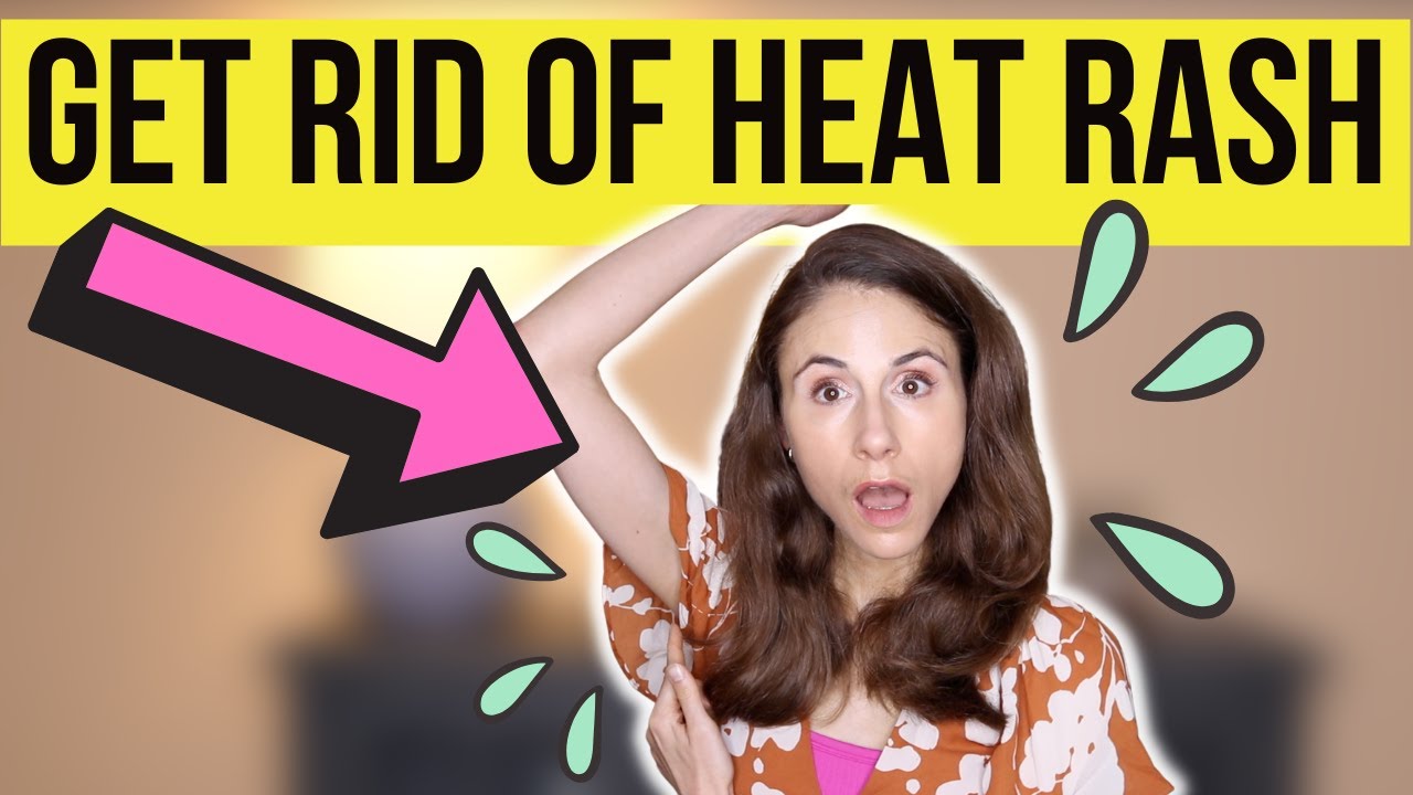 HOW TO GET RID OF HEAT RASH FAST! Dermatologist @DrDrayzday