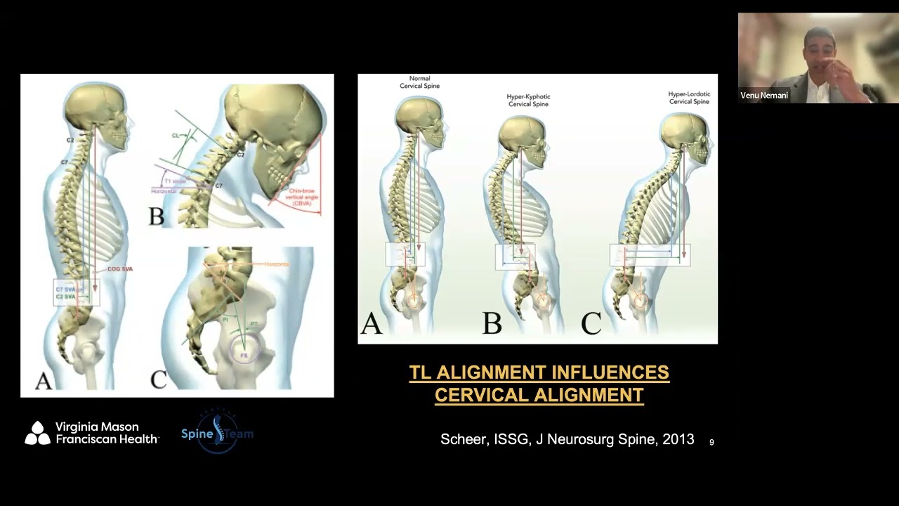Cervical Deformity – Surgical Decision Making Principles presented by Venu Nemani, MD