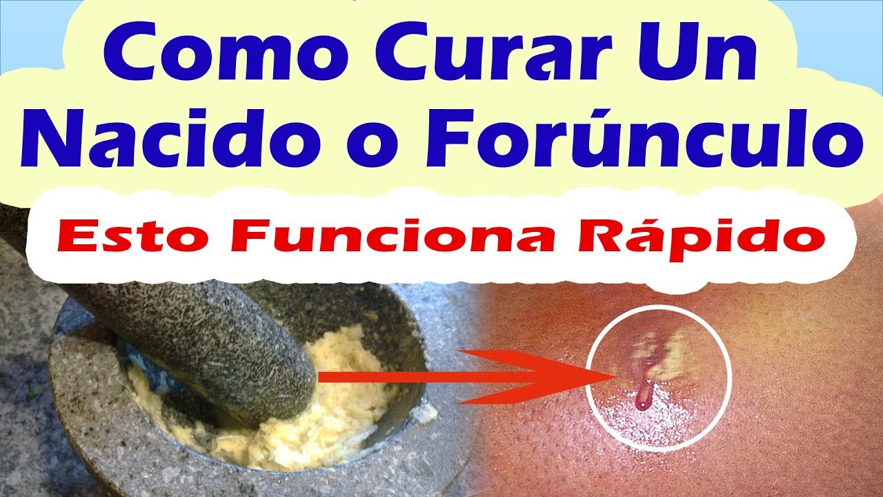 Como Curar Un For&uacute;nculo o Nacido R&aacute;pidamente | Tratamiento Natural Para Madurar Los For&uacute;nculos