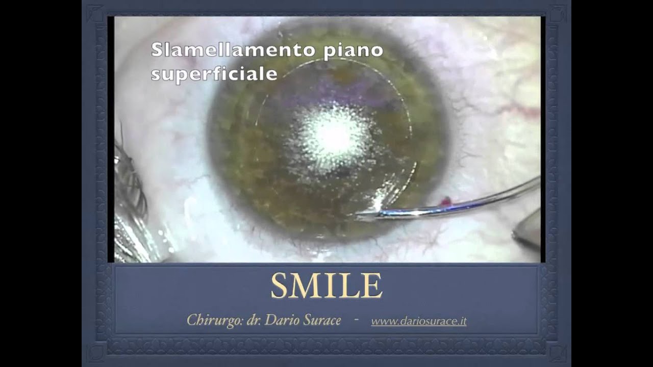 ReLEx&reg; SMILE: come correggere difetti refrattivi. Dr. Dario Surace
