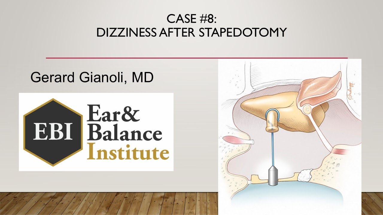 Case 8   Dizziness after Stapedotomy