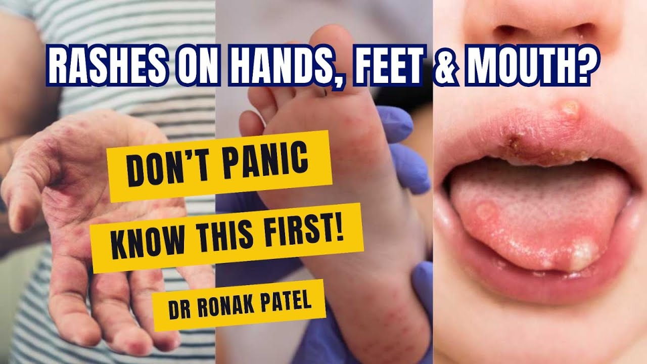 Hand Foot Mouth Disease in Kids | Symptoms, Care & Prevention Explained Simply #kids #kidshealth
