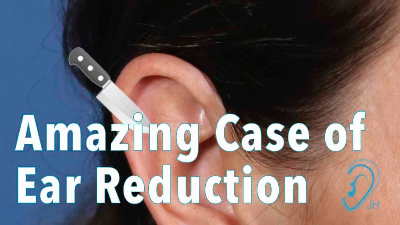 Amazing Macrotia Ear Reduction Results!