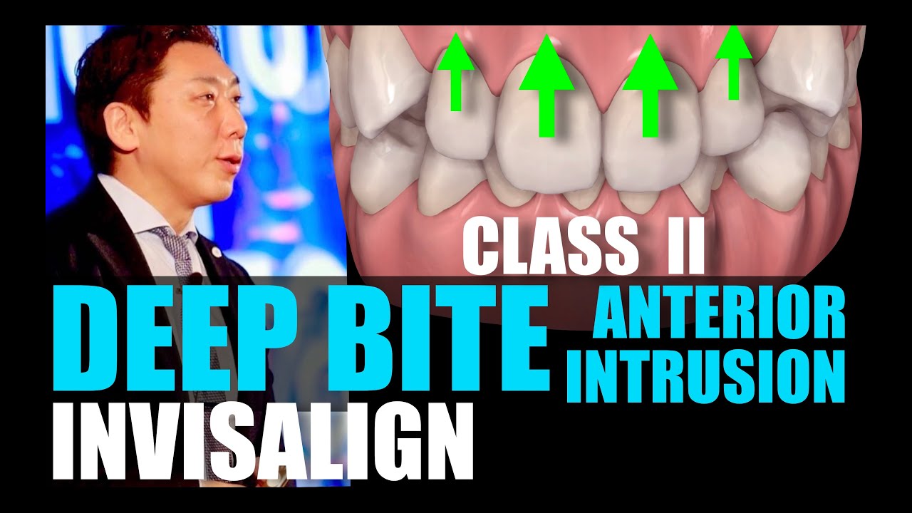 INVISALIGN CLASS II DEEPBITE NON EXTRACTION【インビザライン過蓋咬合】