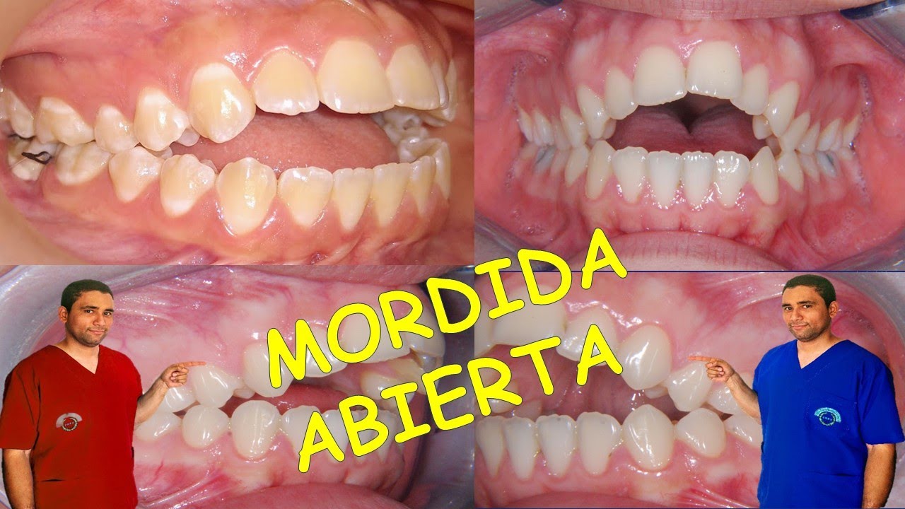3 FORMAS DE CÓMO RESOLVER UNA MORDIDA ABIERTA SEVERA EN ORTODONCIA! 😎