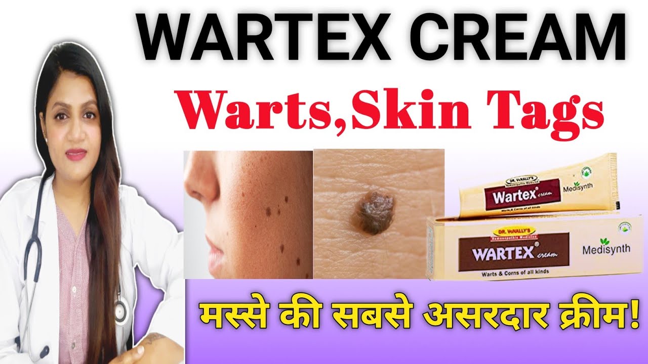 मस्से हटाने की सबसे असरदार क्रीम! wartex homeopathic medicine uses in hindi