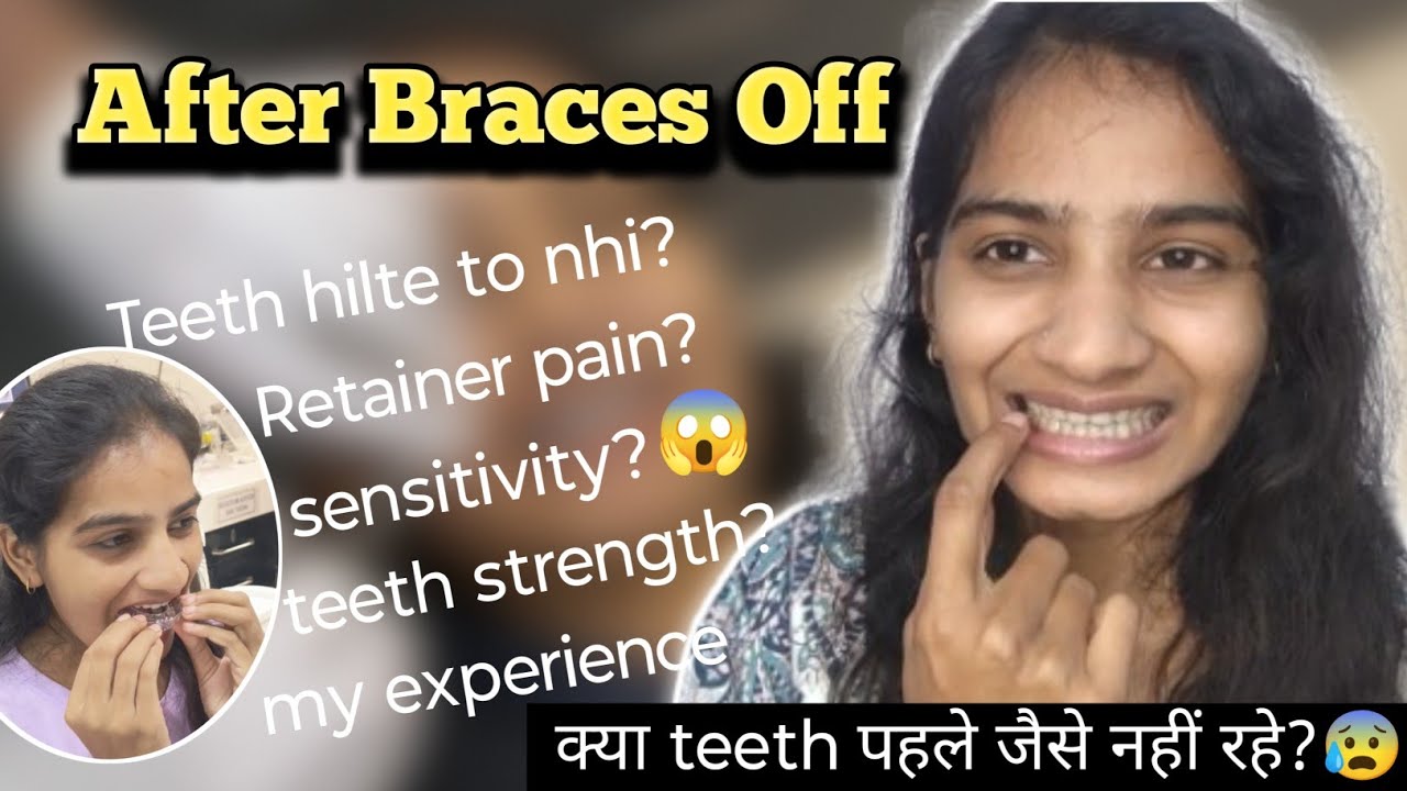 Braces Off hone ke baad kya kya problems hoti hai ?😰 |Teeth hilte to nhi? Sensitivity teeth strength