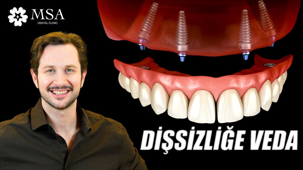 Dişsizliğe Karşı Yenilikçi Çözüm: All-on-4 İmplant Tedavisi ile Kısa Sürede Yeni Dişler