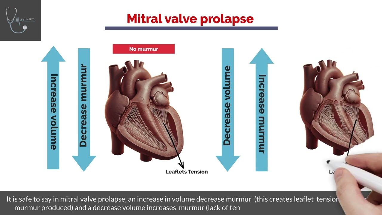 mitral valve prolapse explained in 2 minutes 
