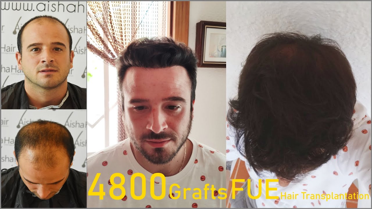 FUE Hair Transplant Transformation / Transformación de Injerto Capilar FUE