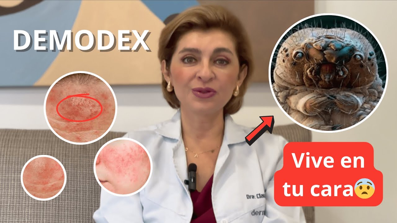 &iexcl;NO ES ACN&Eacute;, ES DEMODEX! El &aacute;caro que vive en tu piel