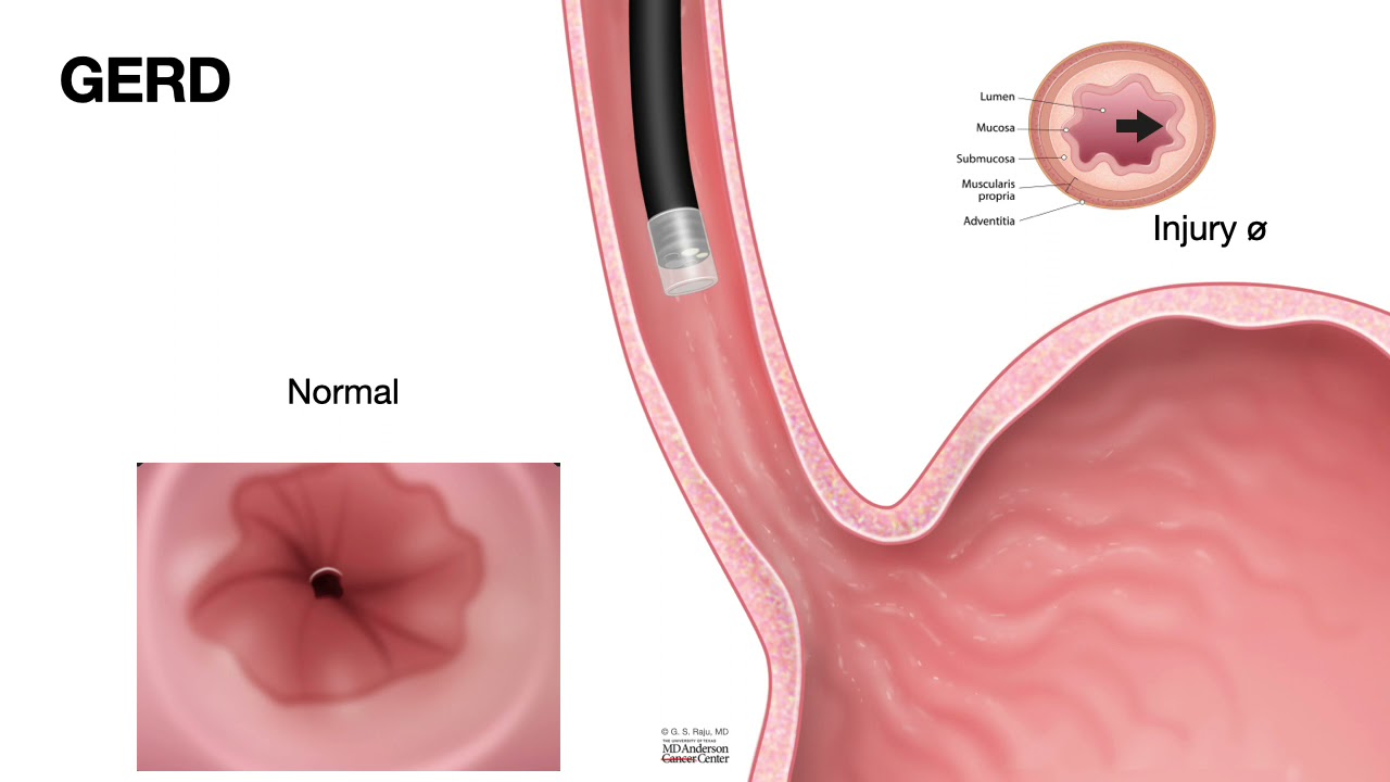 HCC 1475-2e-Pathology of Esophagus - Peptic Stricture