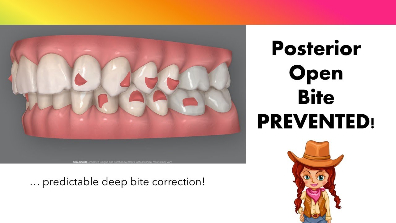 Invisalign ClinCheck - A guaranteed, but preventable, Posterior Open Bite.
