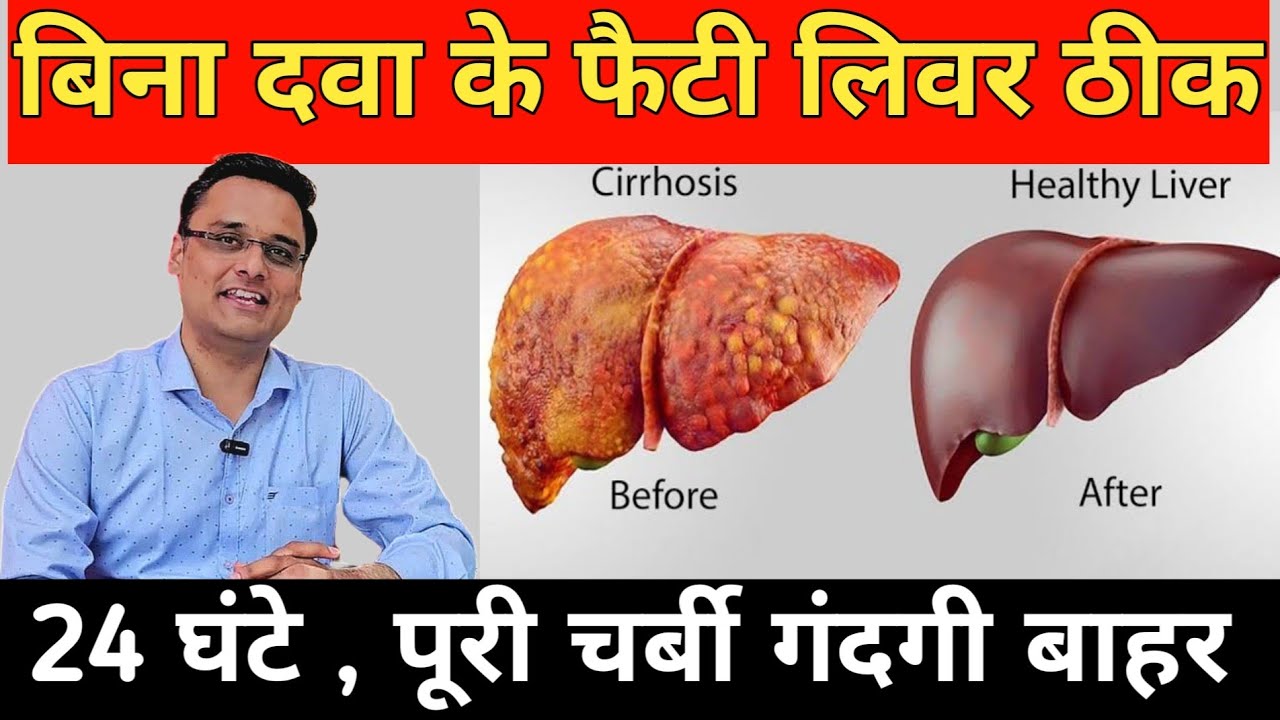 बिना दवा के फैटी लिवर ठीक होगा बस ये कर लो, fatty liver treatment, fatty liver symptoms, diet 