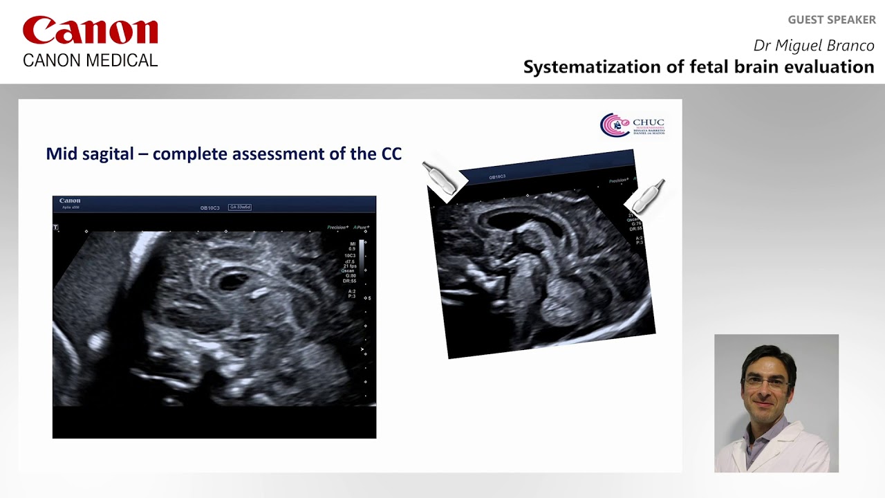 ISUOG 2020 Miguel Branco - Systemization of fetal brain evaluation