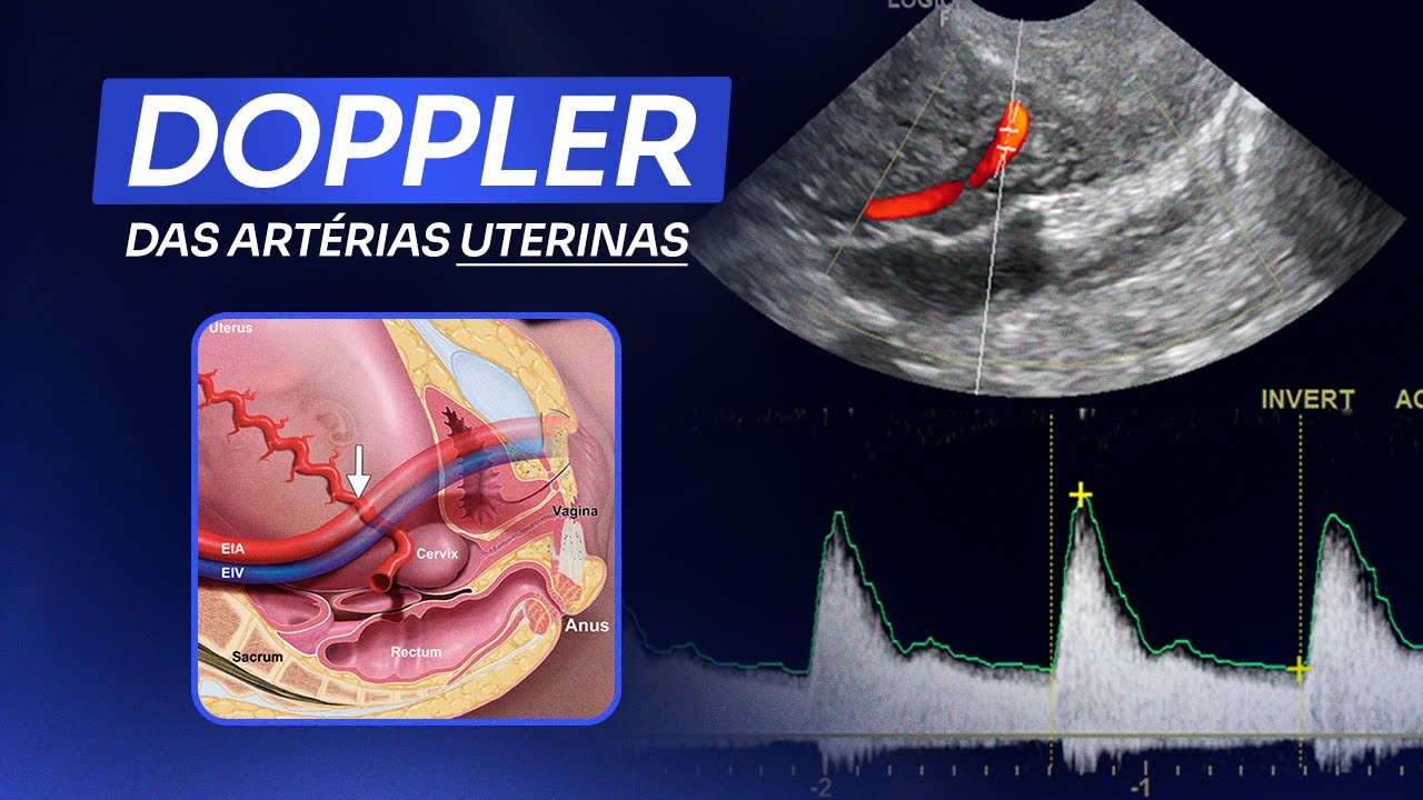 Doppler das Artérias Uterinas | Ultrassom obstétrico