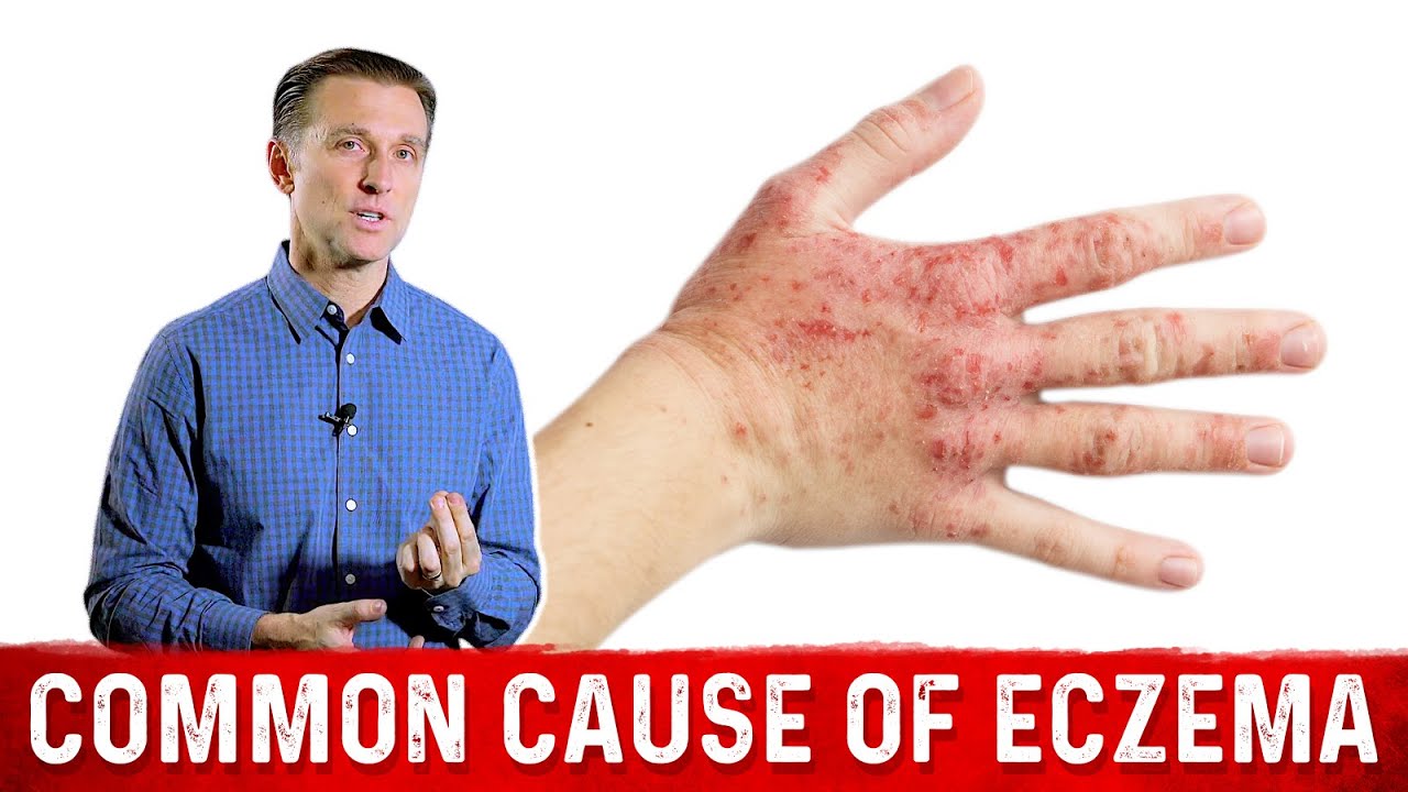 Is Your Eczema Coming from a Salicylate Sensitivity? &ndash; Dr. Berg On Atopic Dermatitis