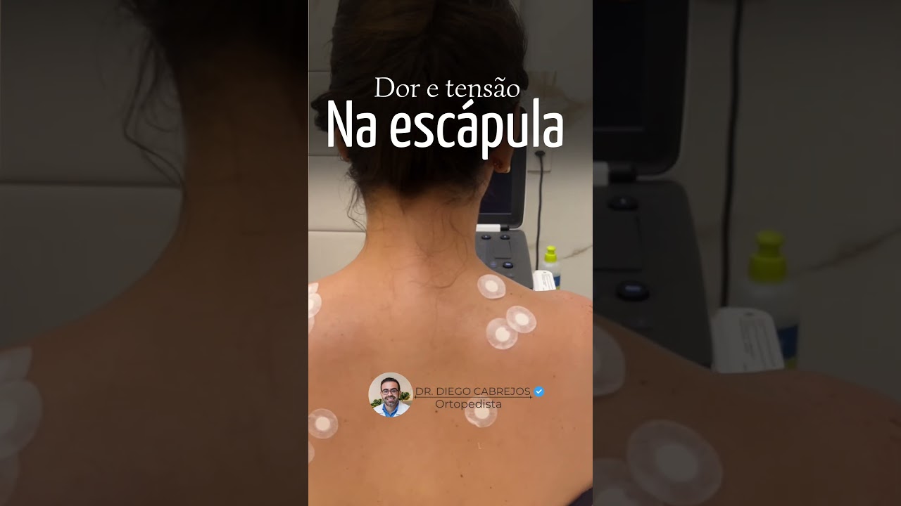 Dor na esc&aacute;pula e tens&atilde;o muscular: infiltra&ccedil;&atilde;o de pontos gatilhos guiada por ultrassom
