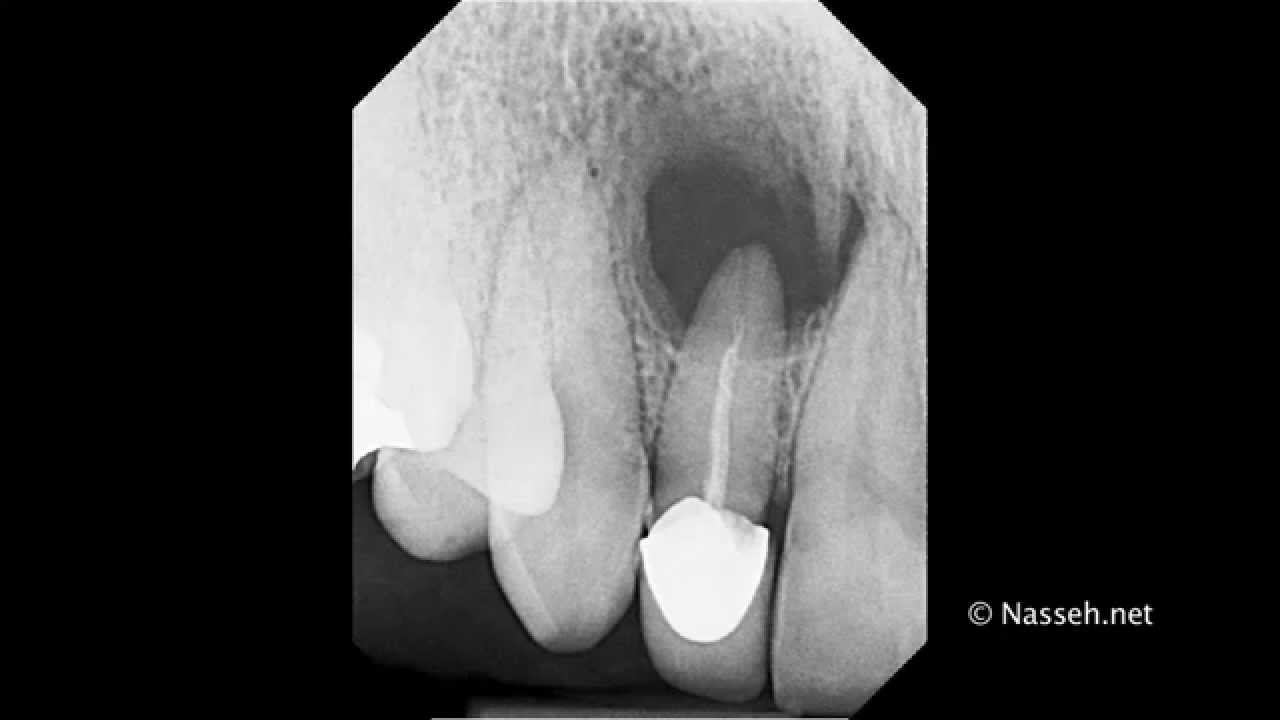 Retrograde / Orthograde Root Canal Therapy Nasseh.net tutorial