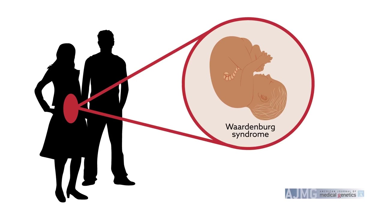 Biallelic Deletion In SOX10 Gene Causes Lethal Form Of Waardenburg Syndrome