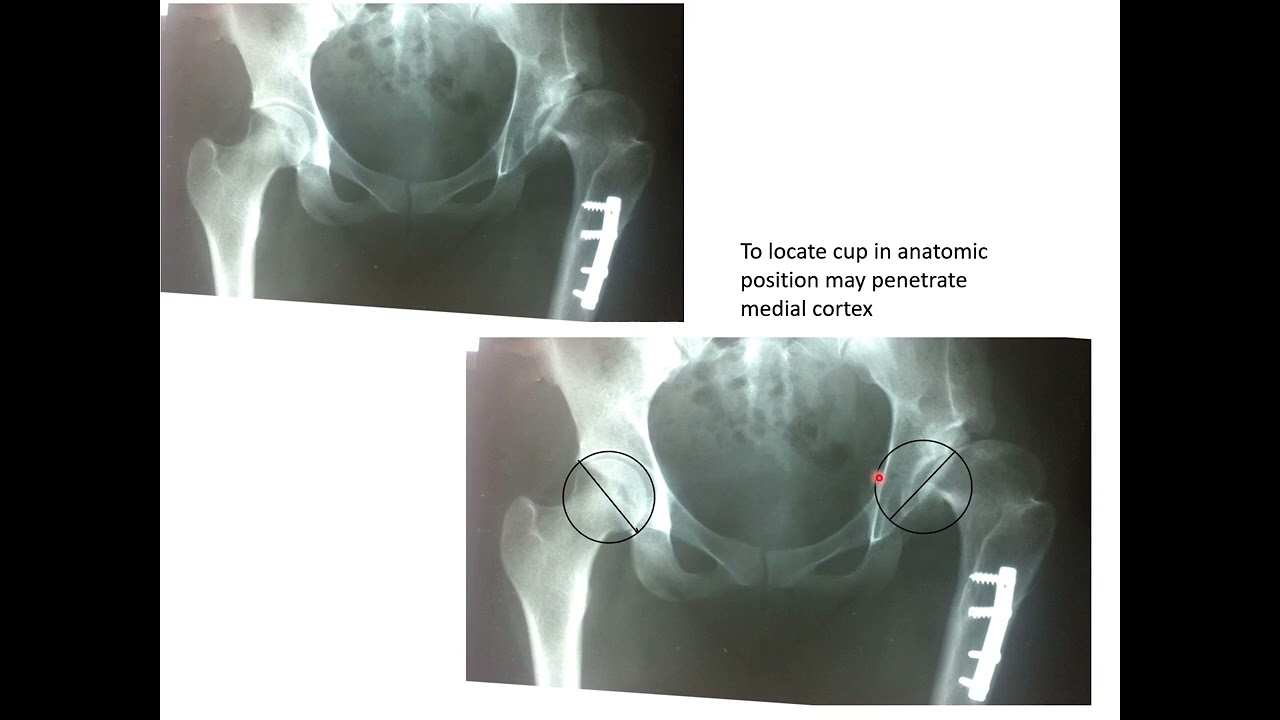 Complex Total Hip Replacement on top of previous Salter op. for DDH in a 26 yrs F.