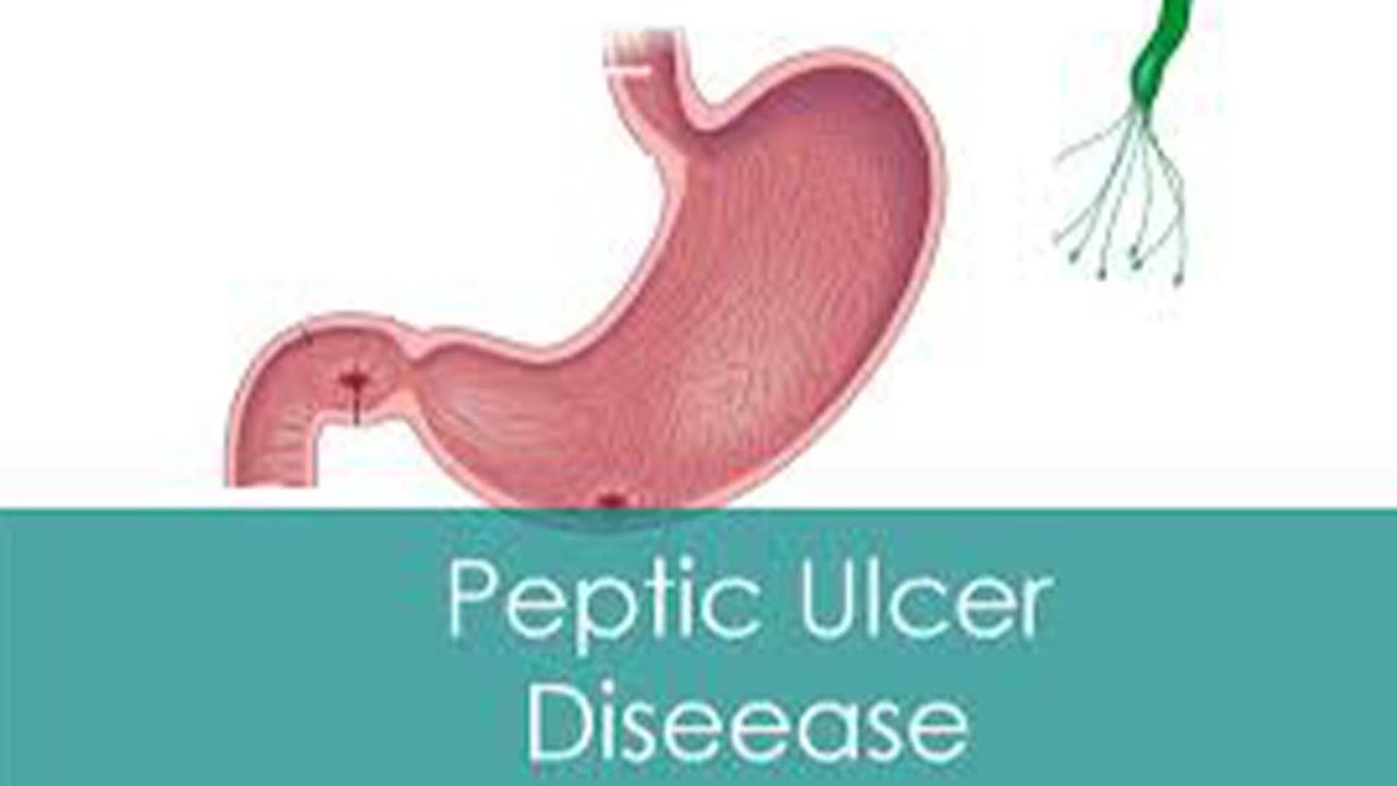 FAHAMU KUHUSU VIDONDA VYA TUMBO (PEPTIC ULCER DISEASE) | DR.ABDULMALIK THOMAS EFRAHIM