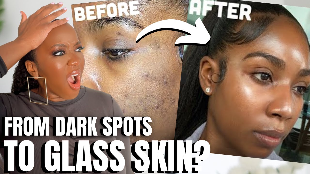 Reacting to How I Cleared My Acne + HYPERPIGMENTATION & Got Glass Skin