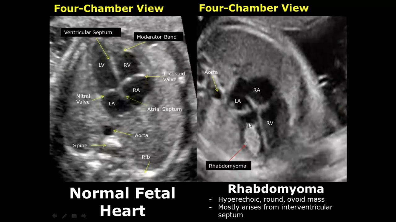Fetal Chest Ultrasound Normal Vs Abnormal Image Appearances | Echocardiography | Heart & Lungs USG