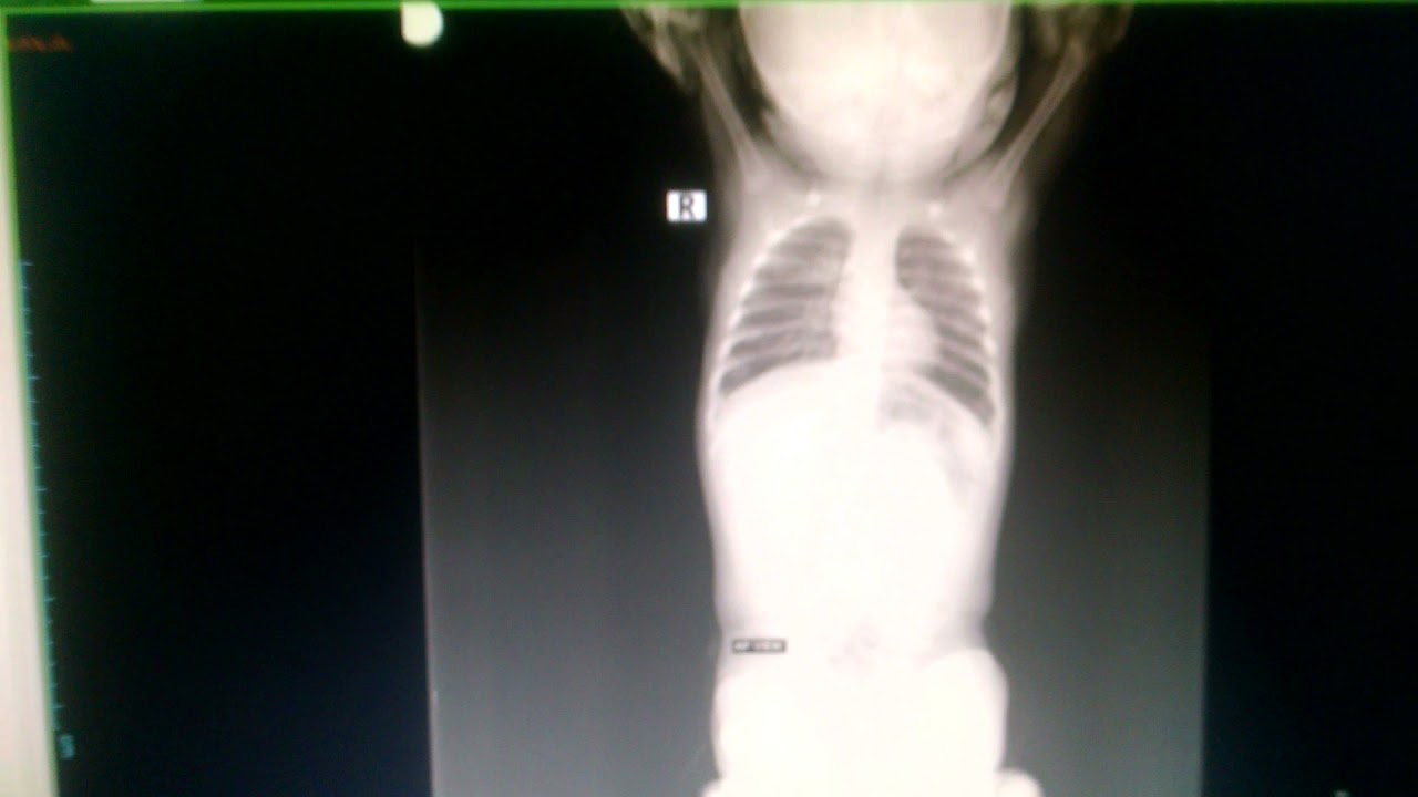 baby chest x ray baby chest x ray restraint baby chest x ray exposure baby chest x ray contraption b