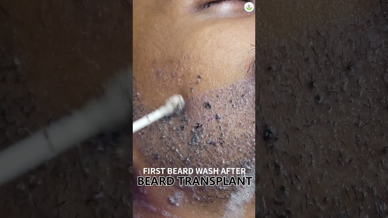 First Beard Hair Wash After Transplant | Post Beard Transplant Care Tips | Care Well Medical Centre