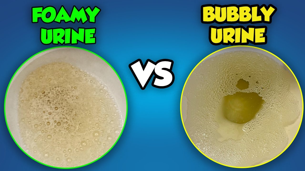 Foamy Urine vs Bubbles in Urine: What is the Difference?