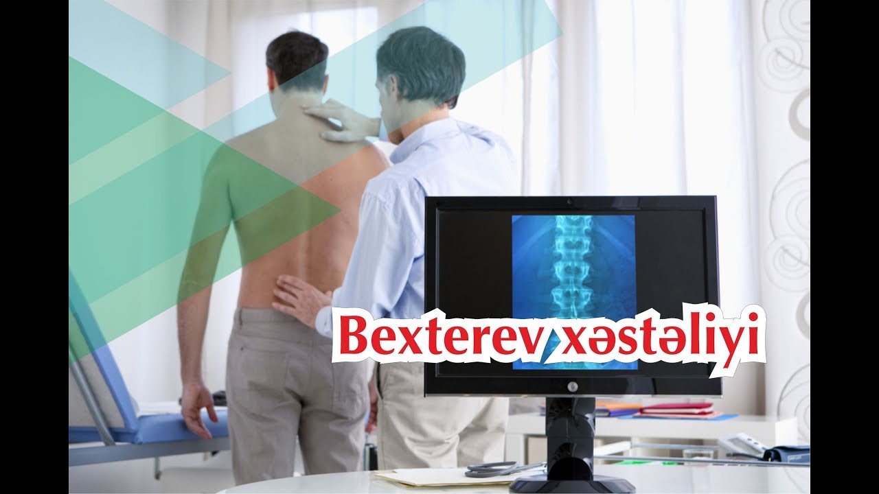 Bexterev xəstəliyi. Hərəkətsiz onurğa. Autoinflammator genetik xəstəliklər.