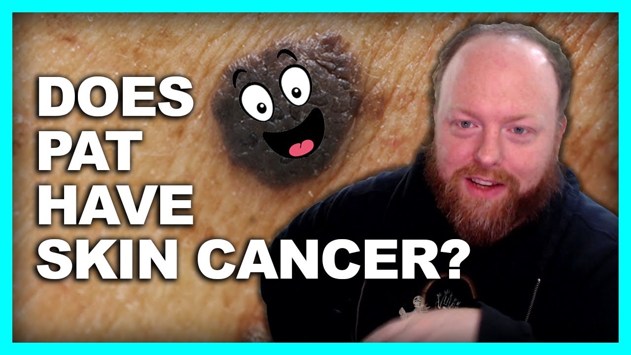 DOES PAT HAVE CANCER? --  MOLES AND SKIN CANCER WITH PEACHSALIVA AND PAT STARES AT