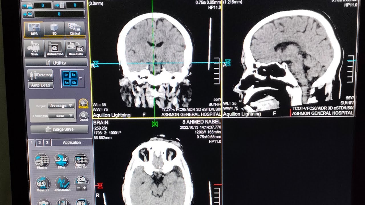 شرح مفصل لفحص الاشعه المقطعيه علي المخ علي جهاز توشيبا الجزء الثاني /CT Brain from A to Z