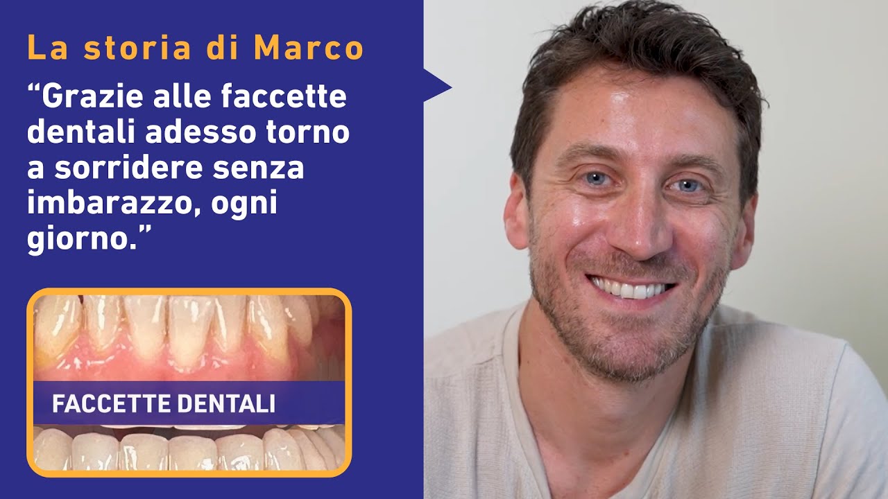 Faccette Dentali: La Trasformazione del Sorriso di Marco