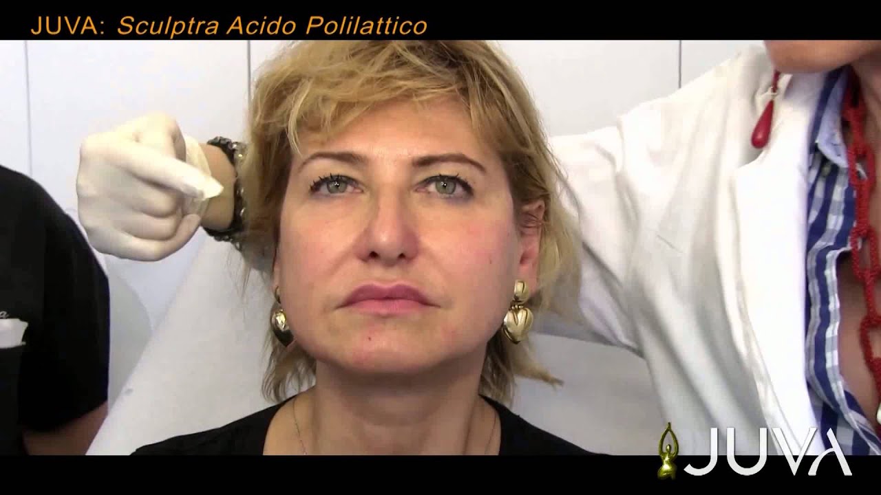 Juva Sculptra: Lifting del viso