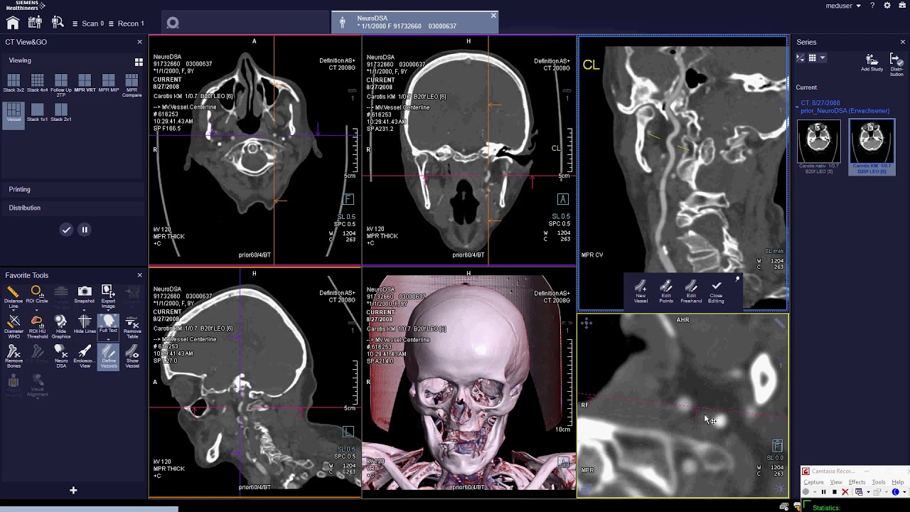 Define Vessels - Curved- SIEMENS CT SOMARIS X or 10شرح السوفت وير الأشعه المقطعيه سيمنس