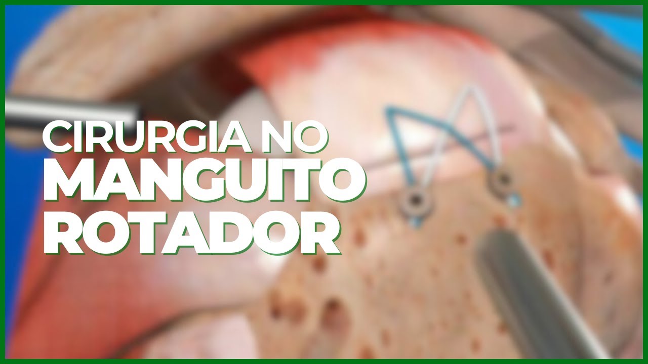CIRURGIA ARTROSCOPIA DO MANGUITO ROTADOR  ›› DR RODRIGO PASTORE ‹‹