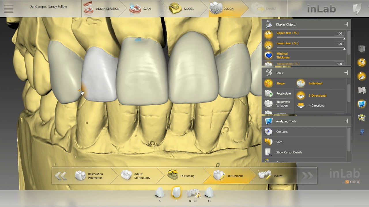 Anterior CAD Design on Sirona InLab 18