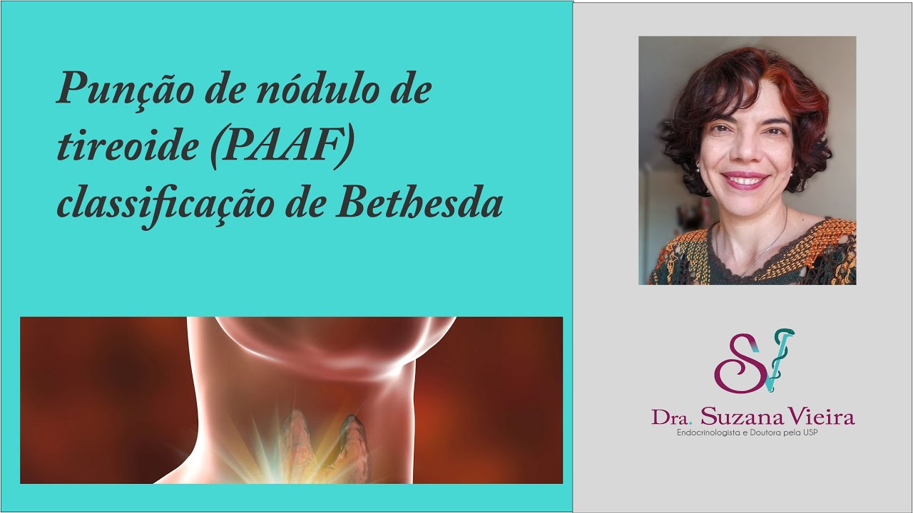 Punção de nódulo de tireoide - Bethesda