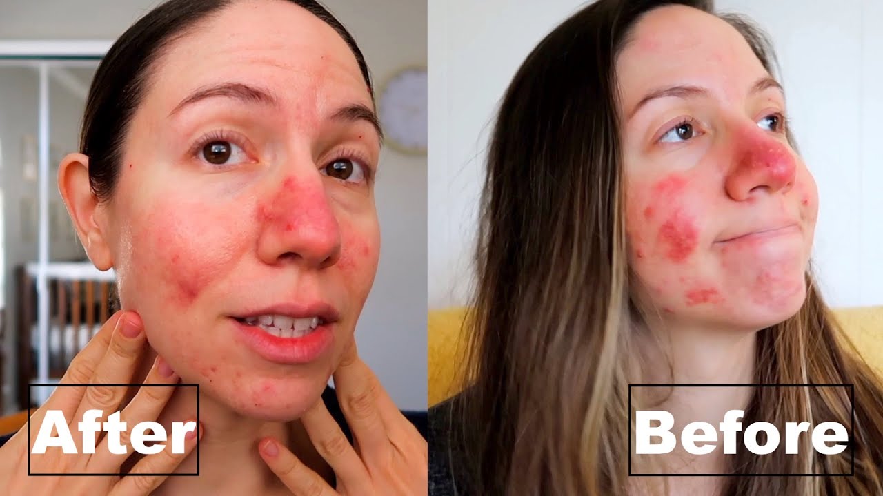 Winter Skincare Routine for ROSACEA // Teami Green Tea Detox Mask Review (AD)