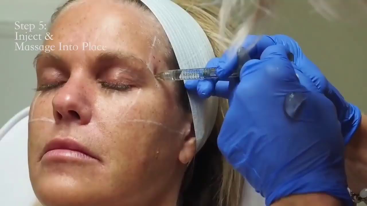 Temple Filler Injections
