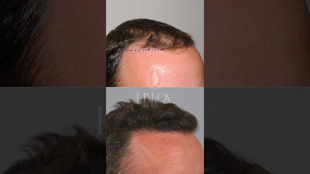 INCREDIBLE FUE Hair Transplant Results!