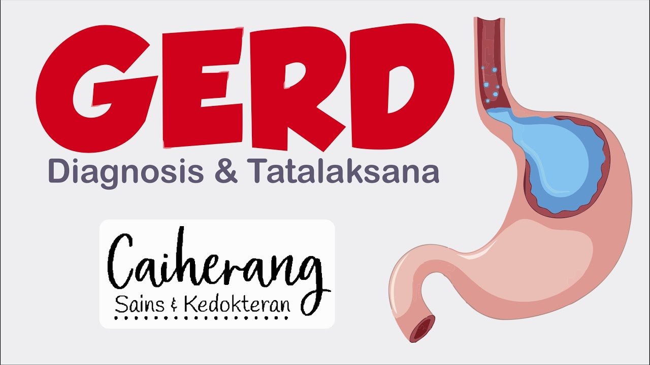 Diagnosis dan Tatalaksana Penyakit GERD (Gastroesophageal Reflux Disease)