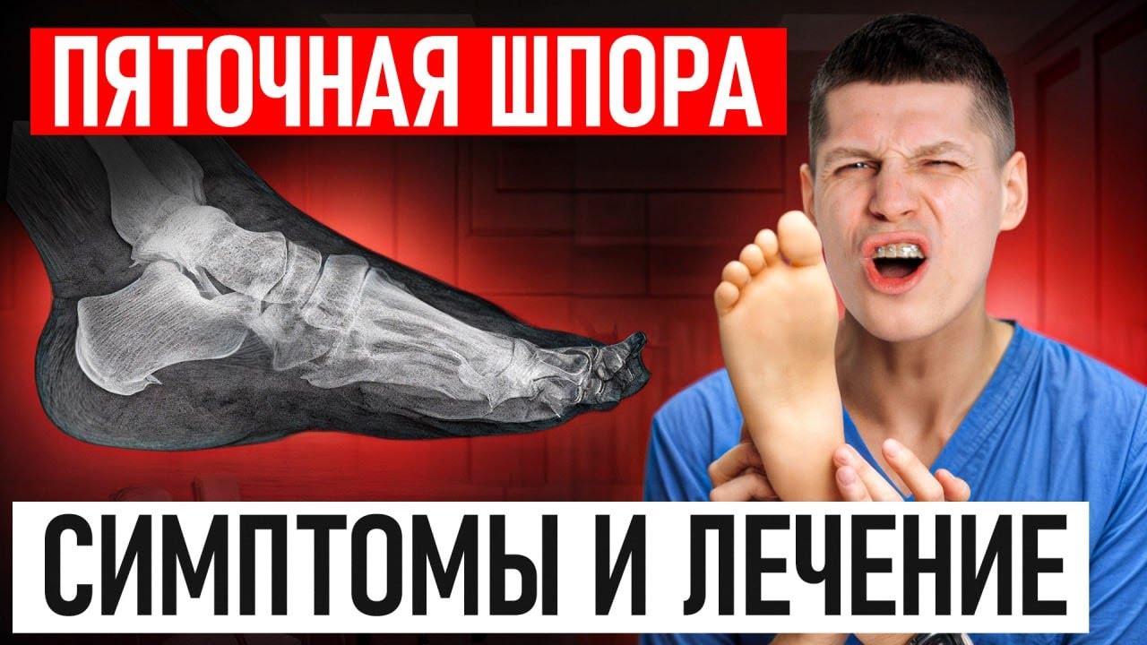 ГЛАВНАЯ причина, почему у ВАС БОЛЯТ ПЯТКИ! Как вылечить БОЛЬ В ПЯТКЕ без врача?