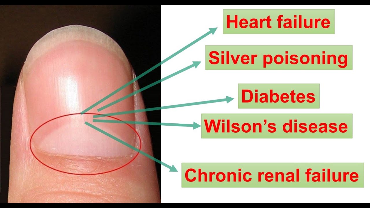 BIOLOGY BEHIND HALF-MOON SHAPE ON OUR FINGERNAILS|| WHITE/BLACK/YELLOW SPOT ON NAIL|| LUNULAE?
